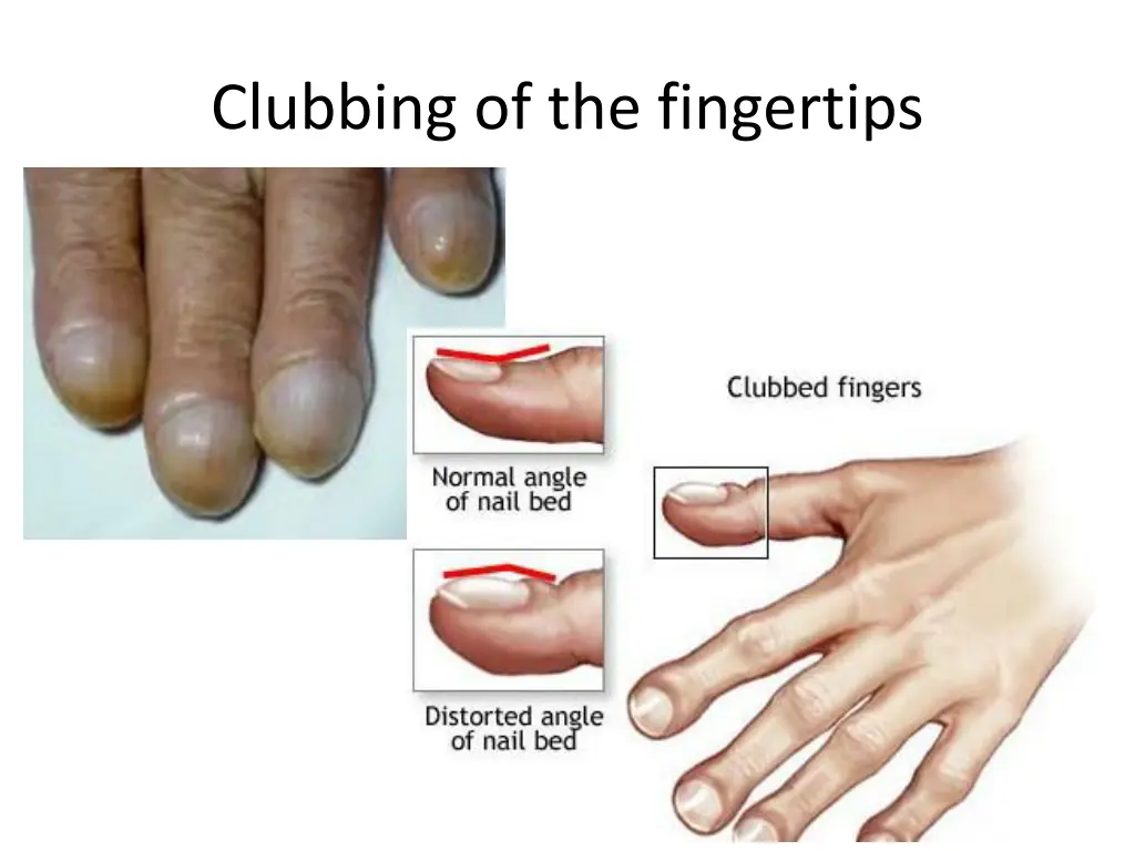 clubbing of the fingertips