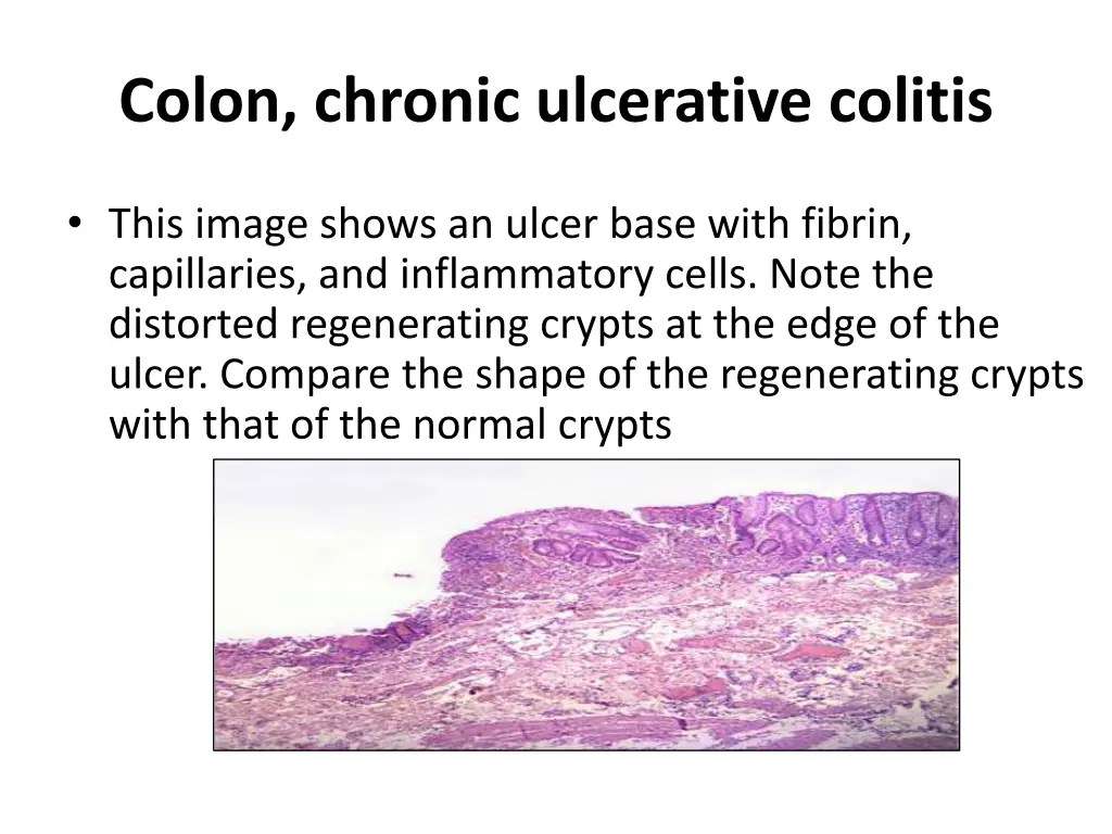 colon chronic ulcerative colitis