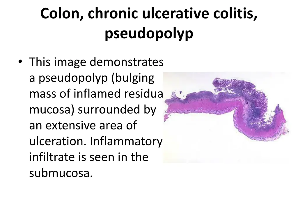 colon chronic ulcerative colitis pseudopolyp