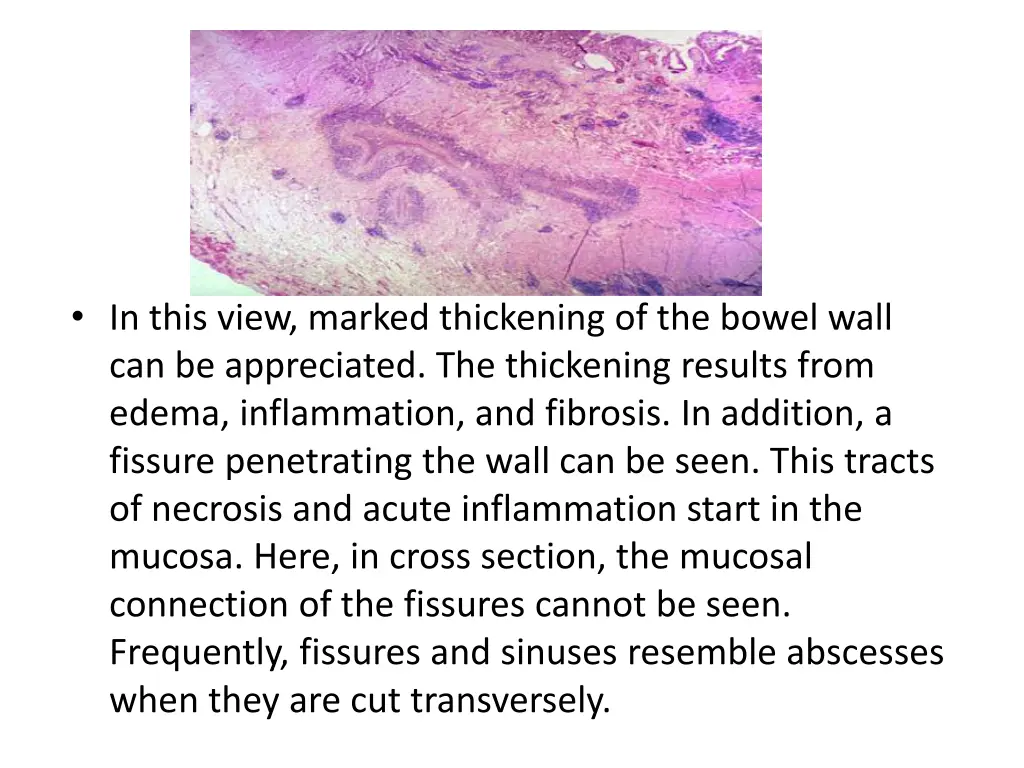 in this view marked thickening of the bowel wall