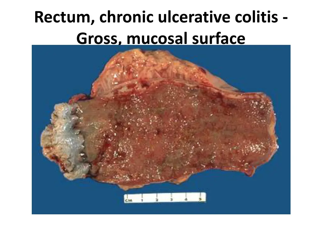 rectum chronic ulcerative colitis gross mucosal