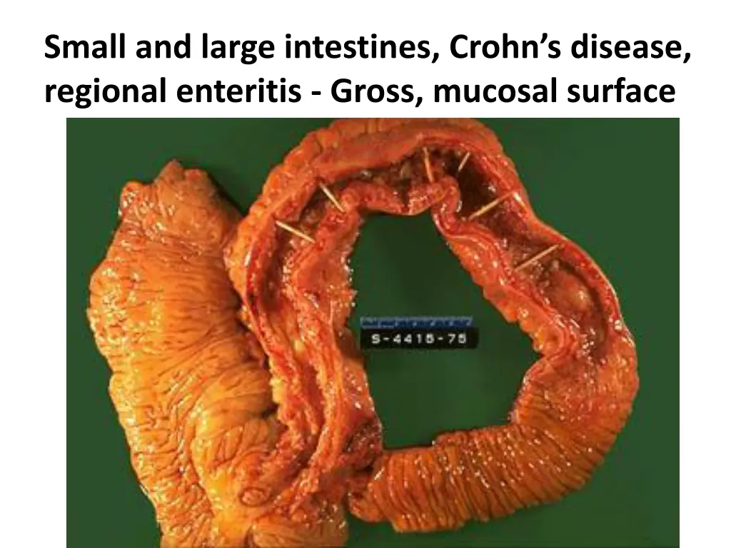 small and large intestines crohn s disease