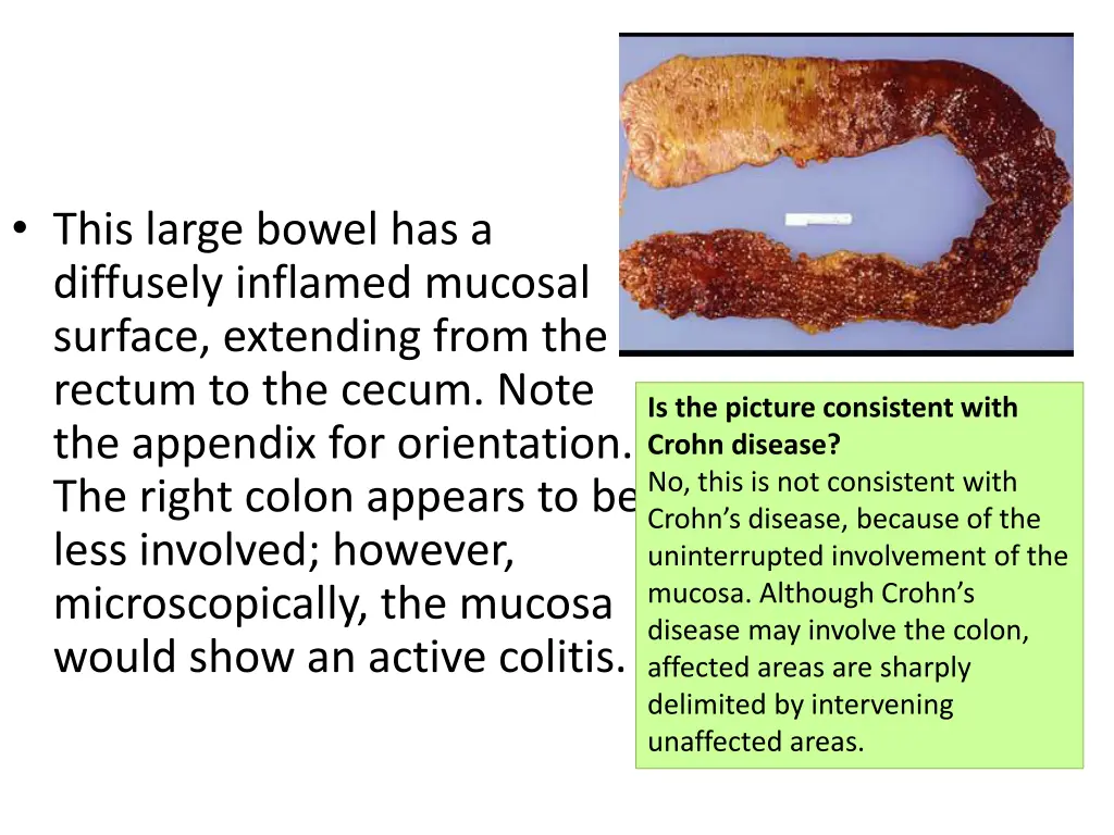 this large bowel has a diffusely inflamed mucosal