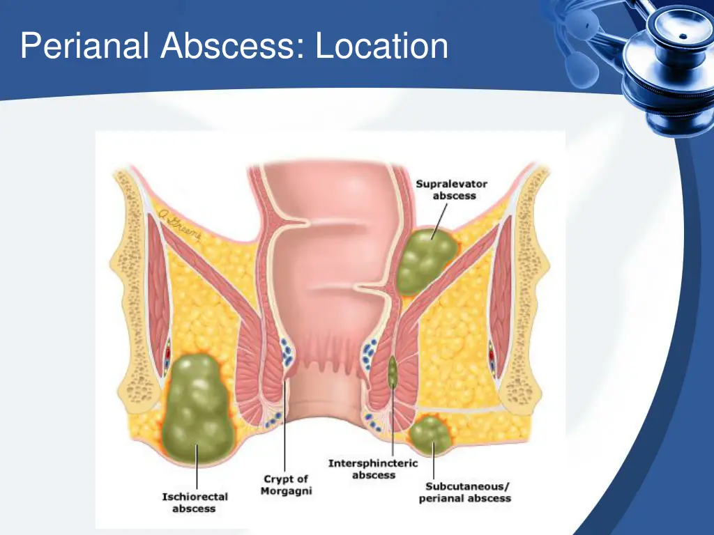 perianal abscess location