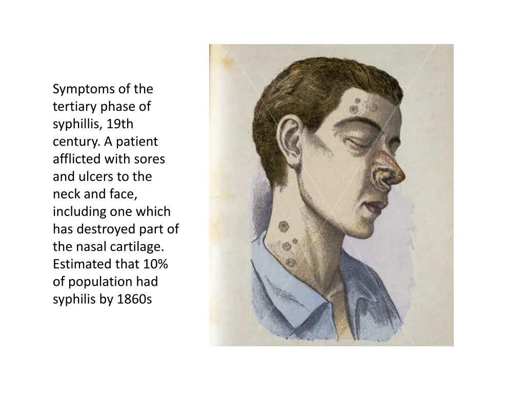 symptoms of the tertiary phase of syphillis 19th