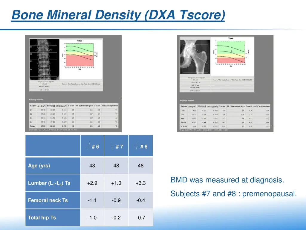 bone mineral density dxa tscore