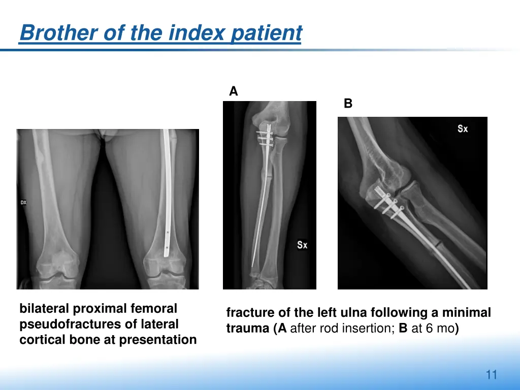 brother of the index patient 1