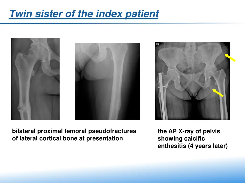 twin sister of the index patient 1