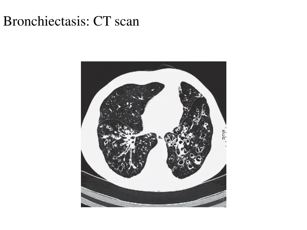 bronchiectasis ct scan