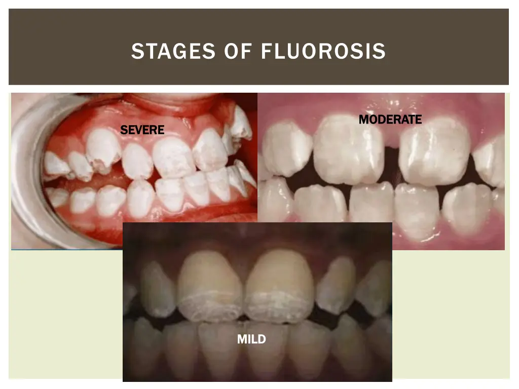 stages of fluorosis