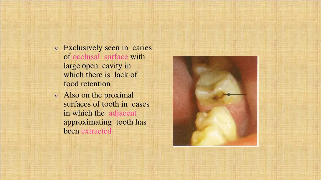 exclusively seen in caries of occlusal surface