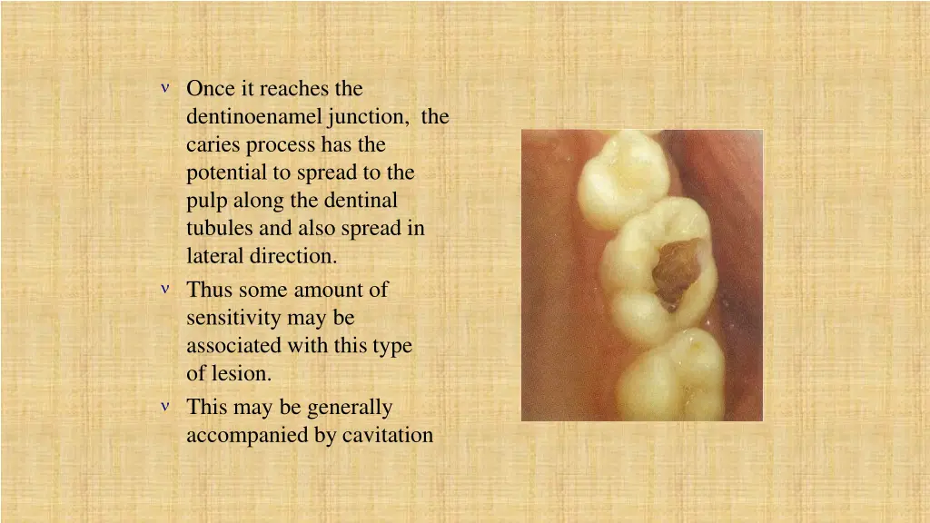 once it reaches the dentinoenamel junction