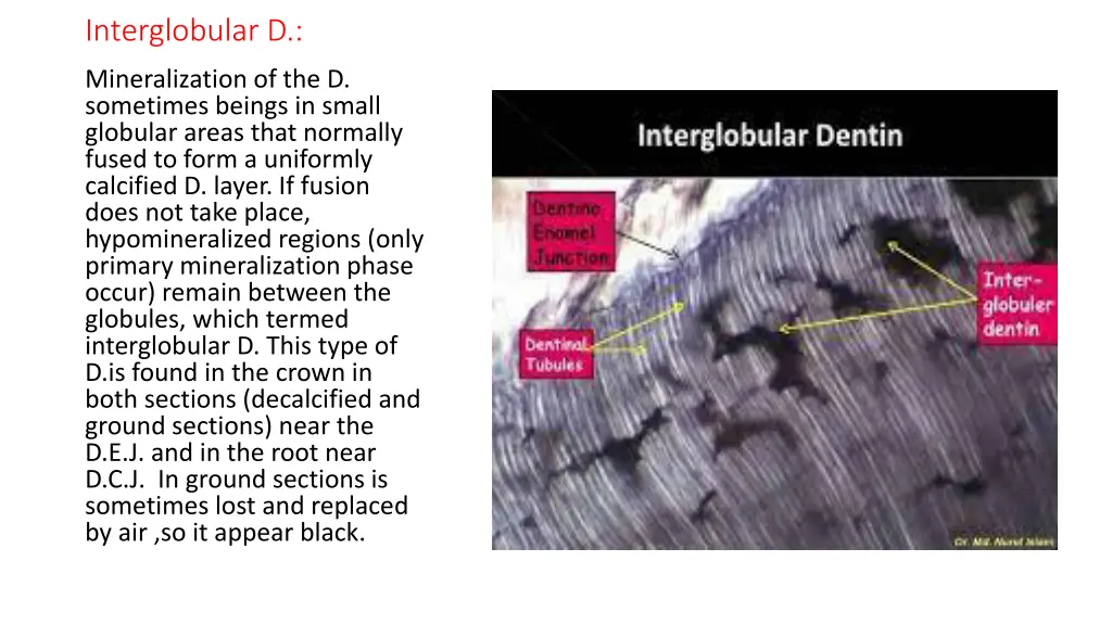 interglobular d