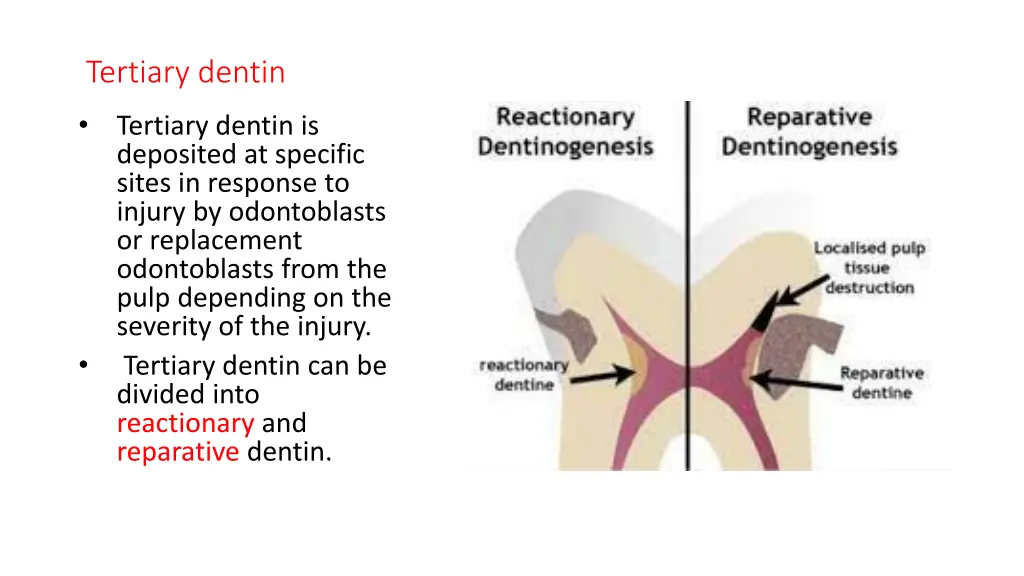 tertiary dentin