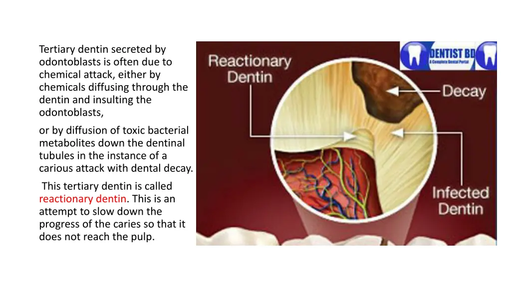 tertiary dentin secreted by odontoblasts is often