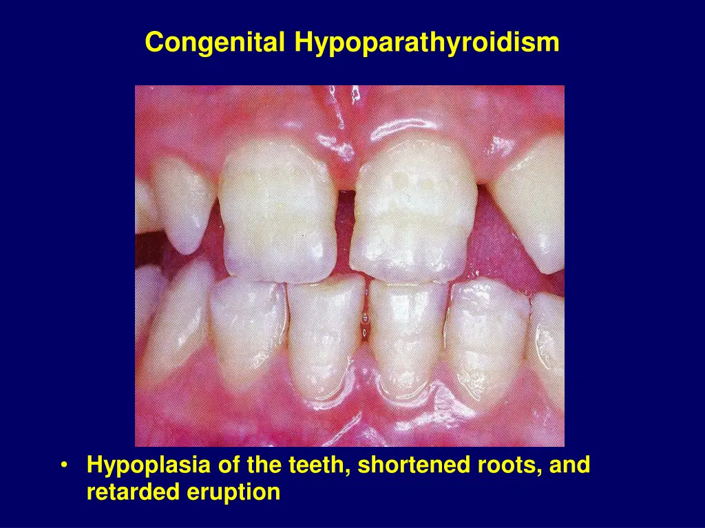 congenital hypoparathyroidism