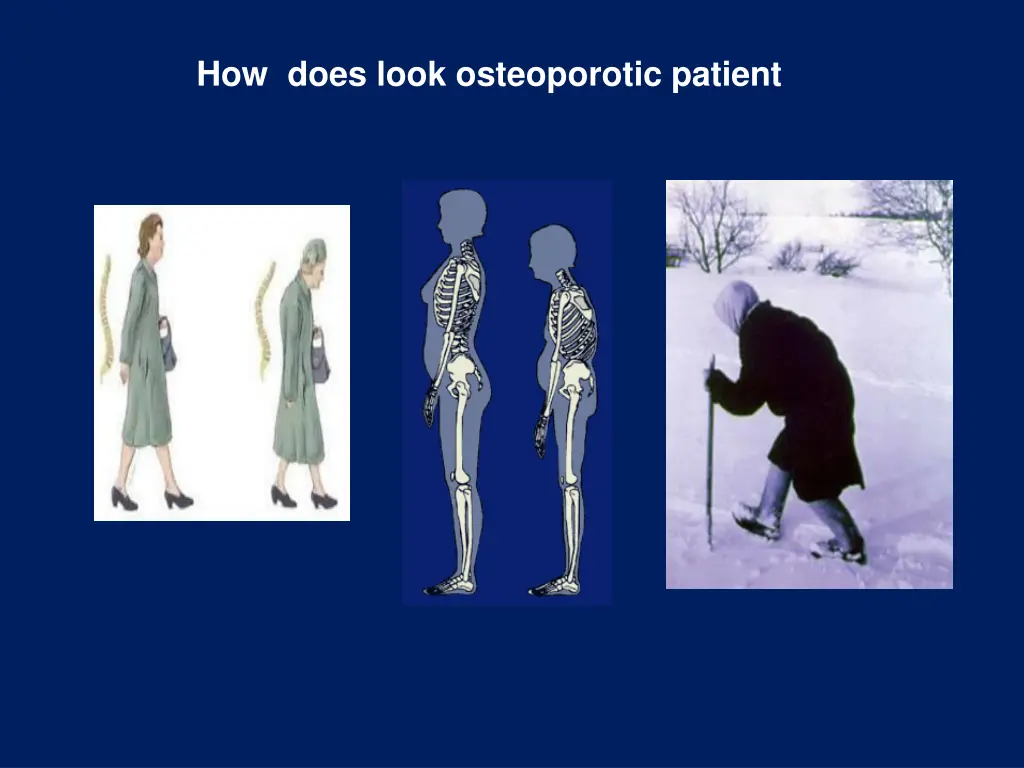 how does look osteoporotic patient