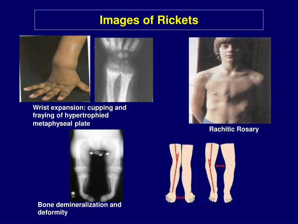 images of rickets