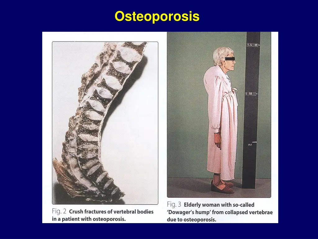 osteoporosis 1