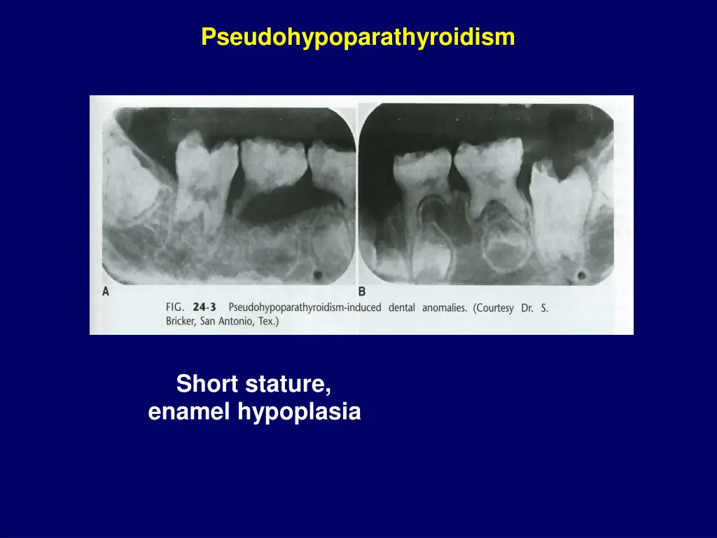 pseudohypoparathyroidism 1