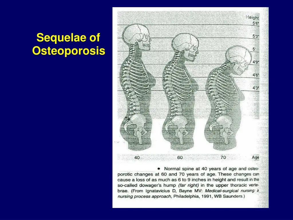 sequelae of osteoporosis