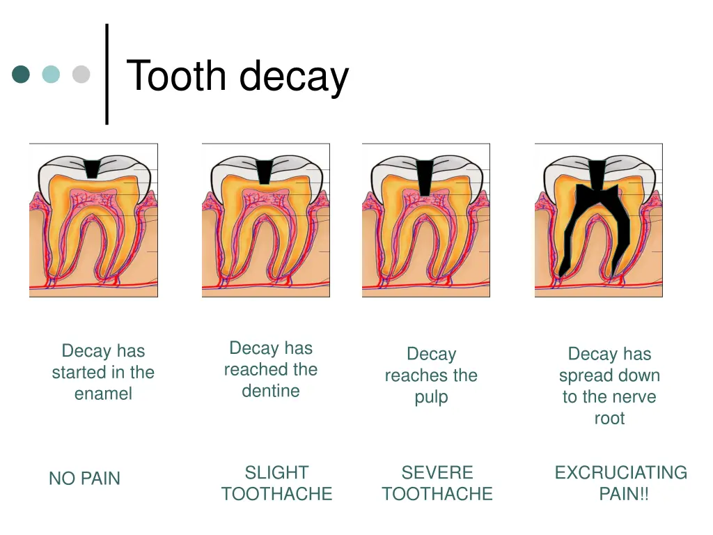 tooth decay 1