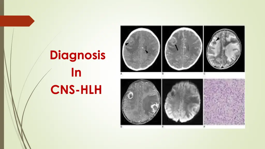 diagnosis in cns hlh