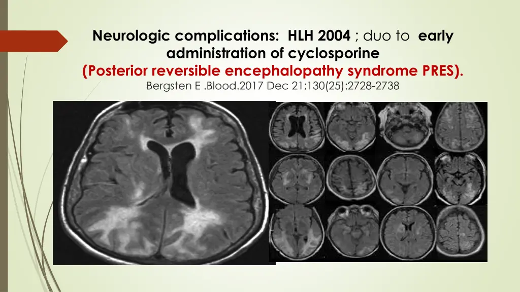 neurologic complications hlh 2004 duo to early