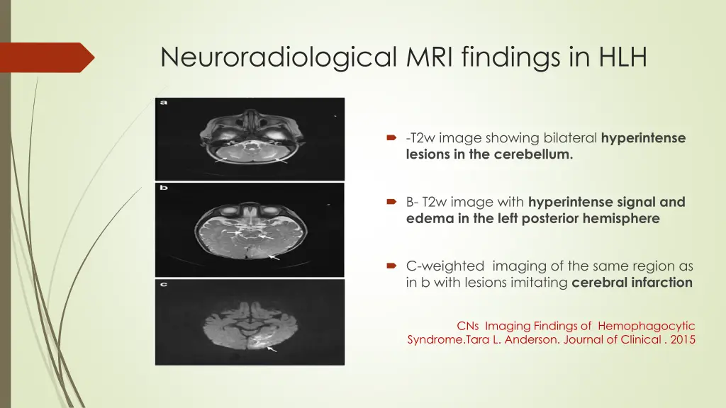 neuroradiological mri findings in hlh