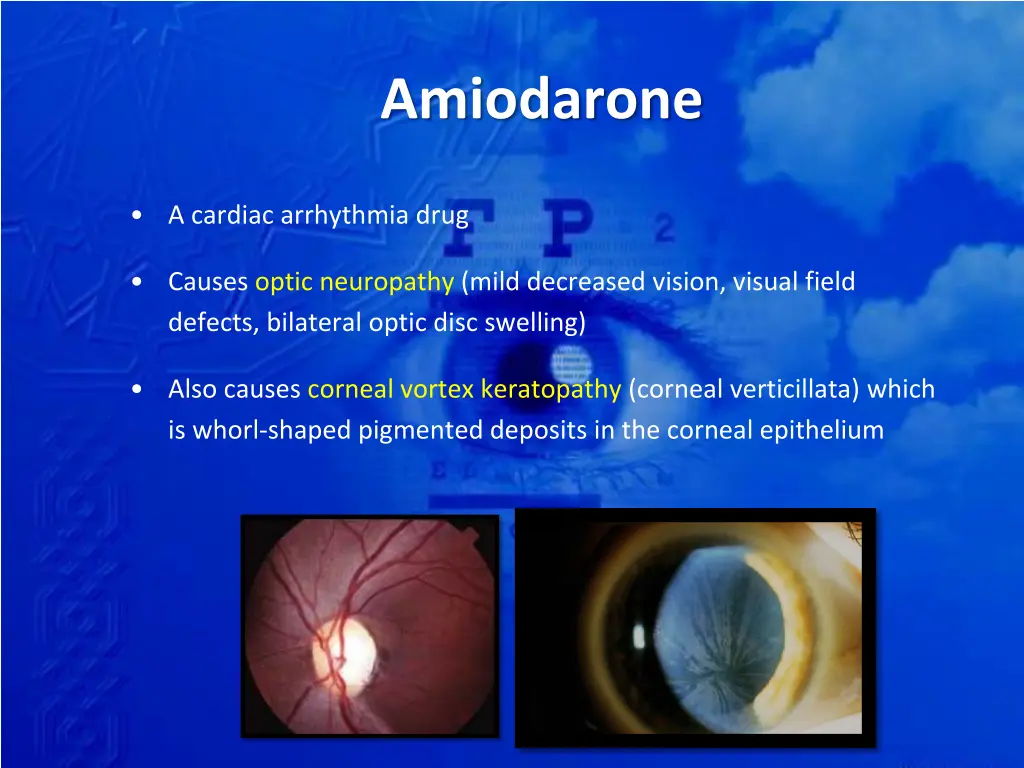 amiodarone