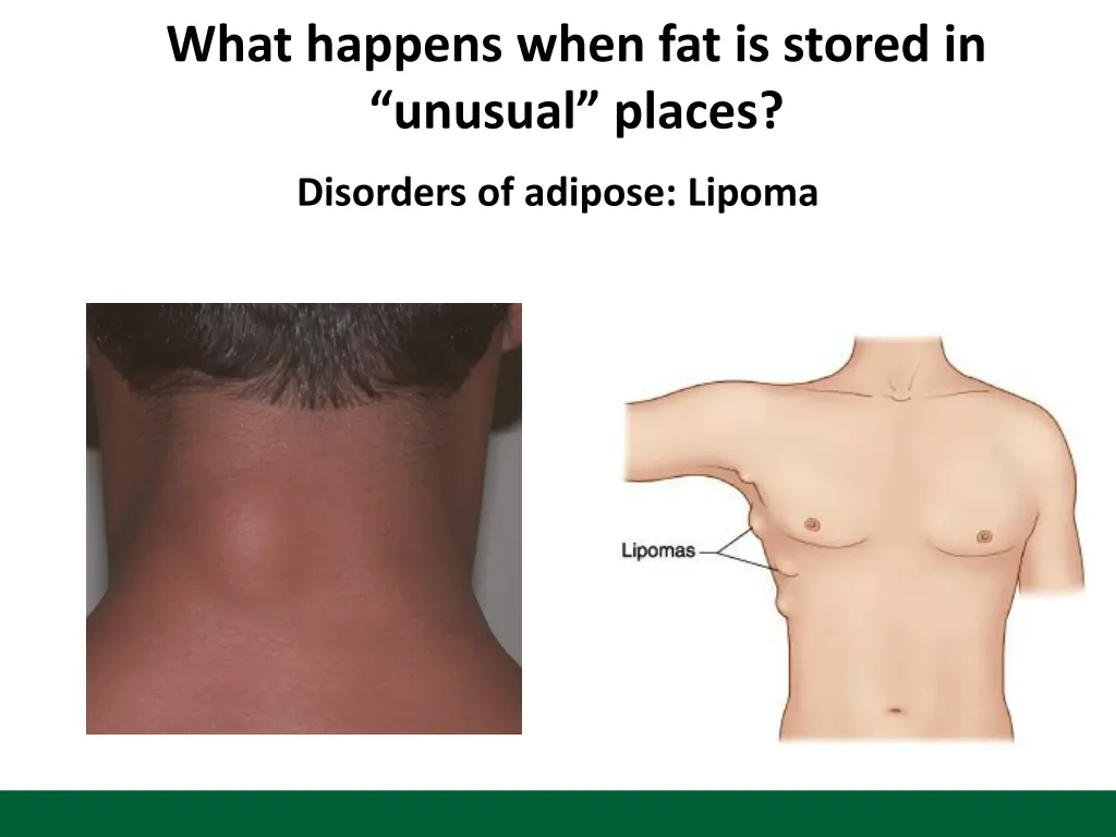 what happens when fat is stored in unusual places