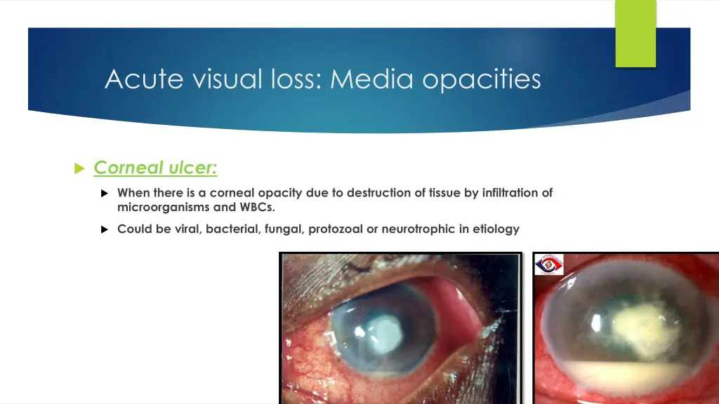 acute visual loss media opacities 1