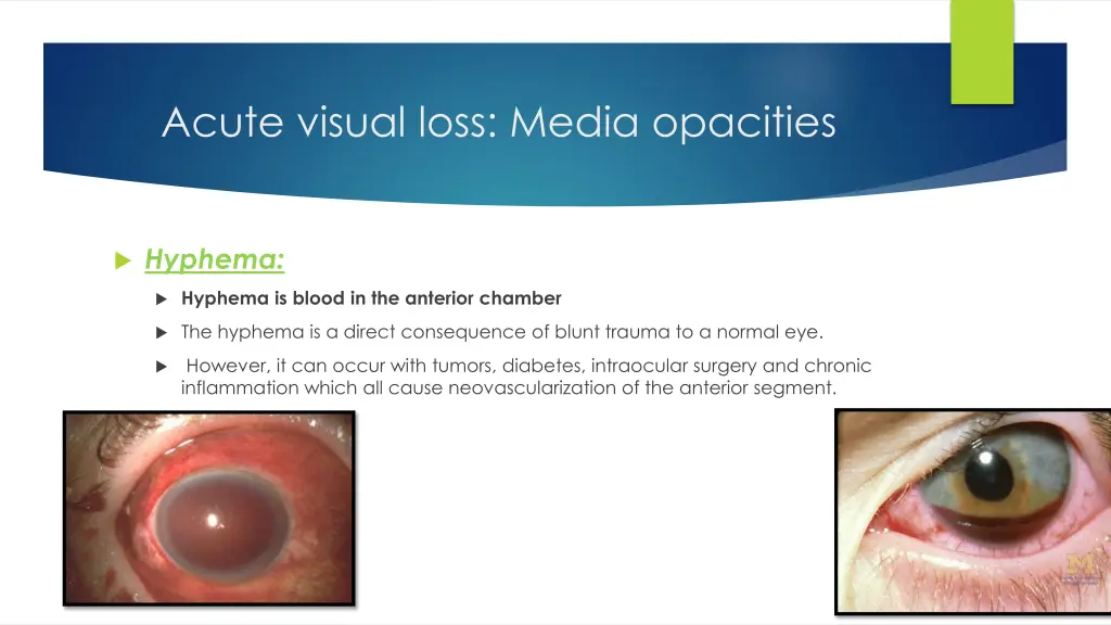 acute visual loss media opacities 2