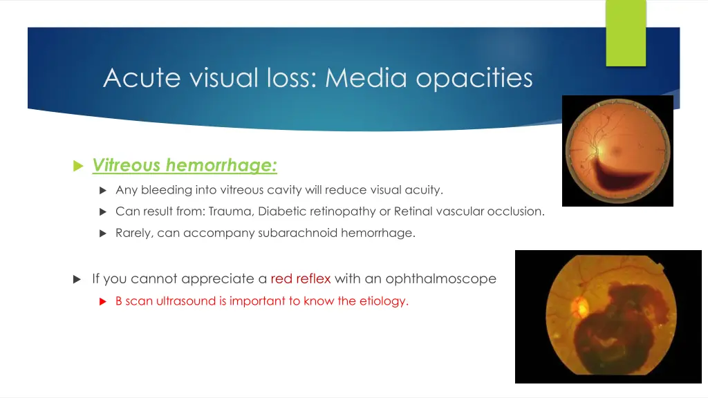 acute visual loss media opacities 3