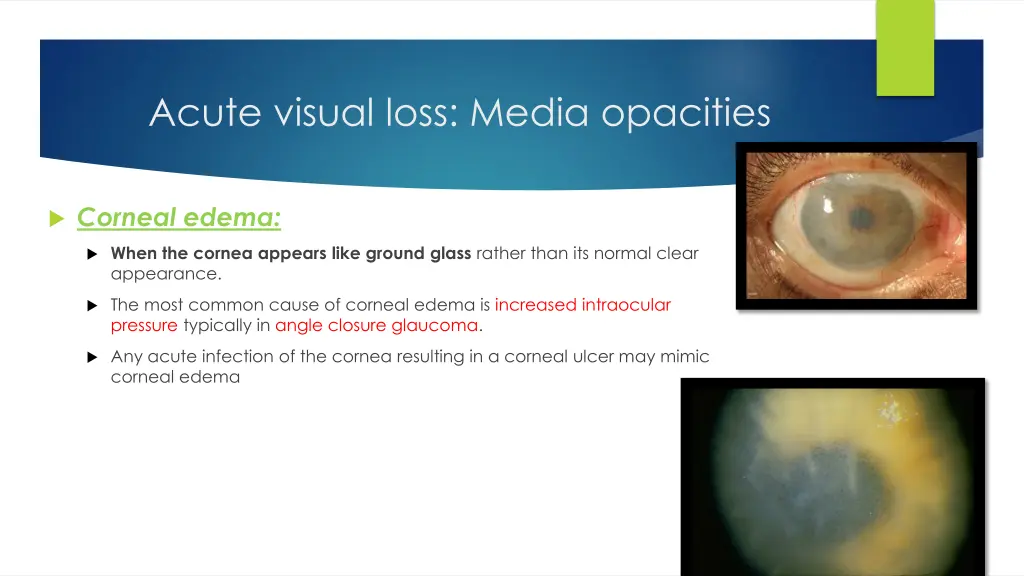 acute visual loss media opacities