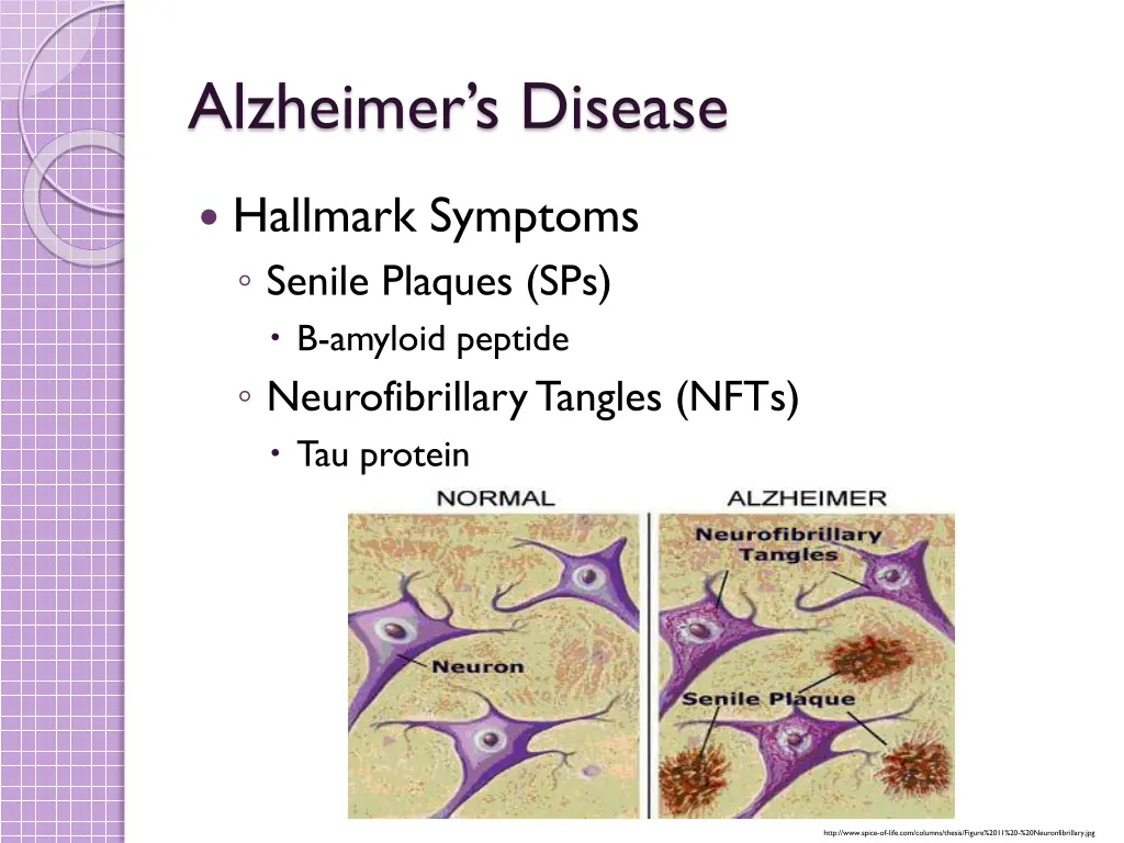 alzheimer s disease