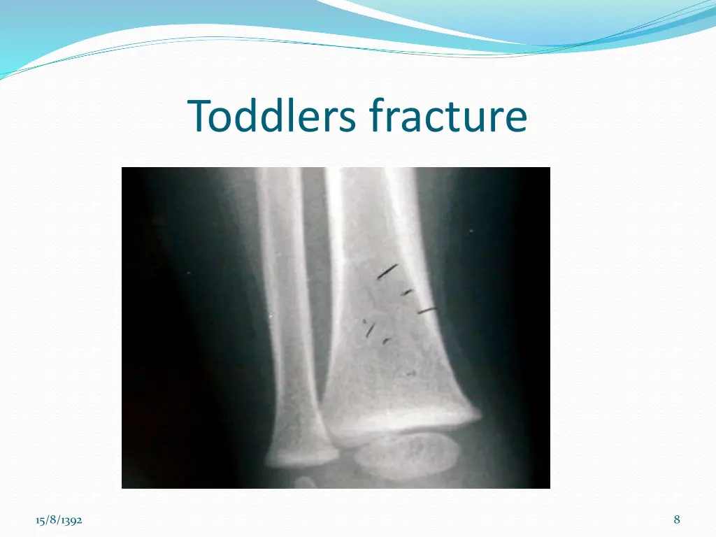 toddlers fracture