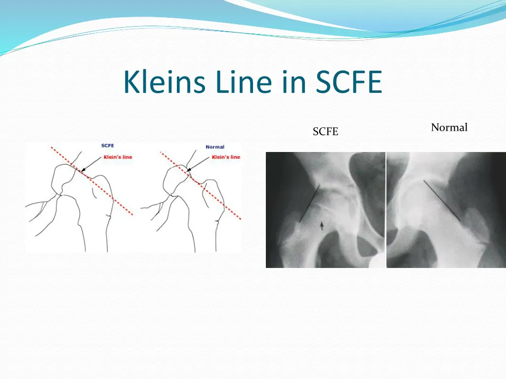 kleins line in scfe