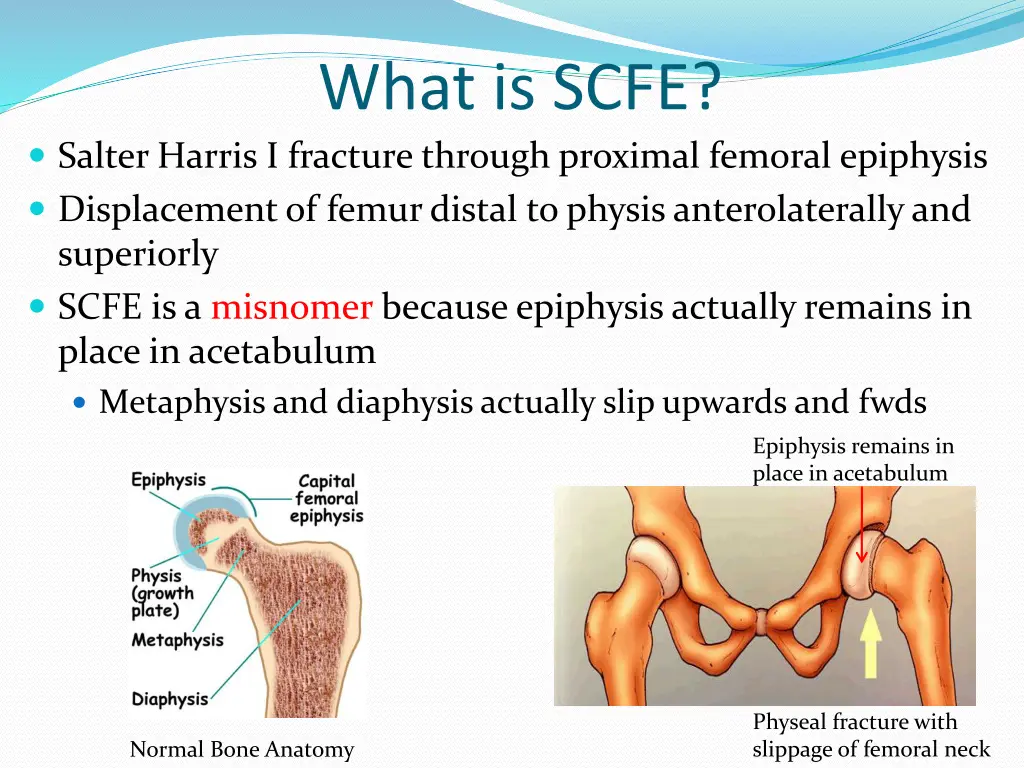 what is scfe