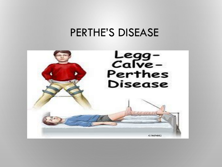 perthe s disease