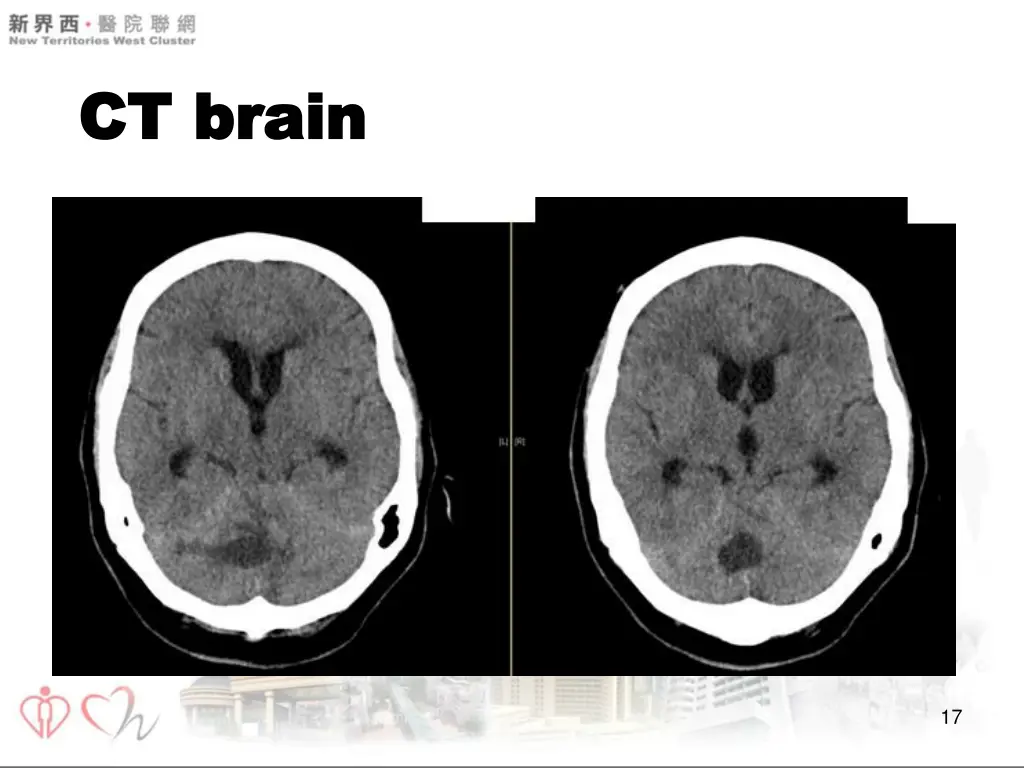 ct brain ct brain 1