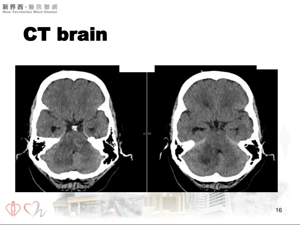 ct brain ct brain