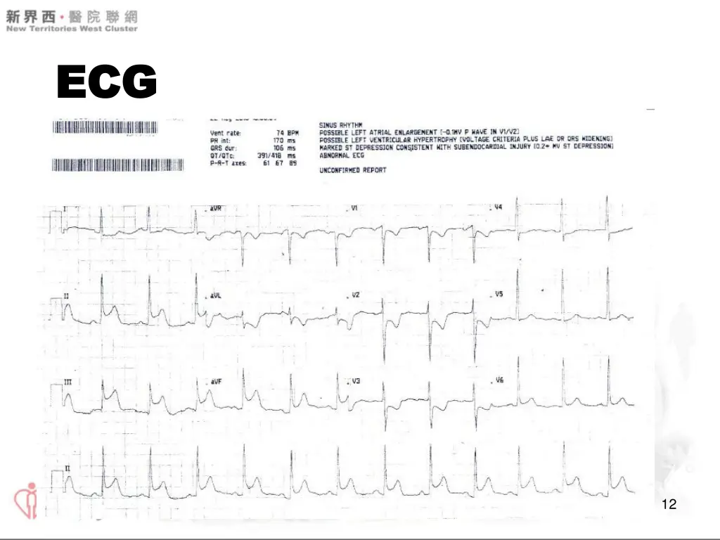 ecg ecg