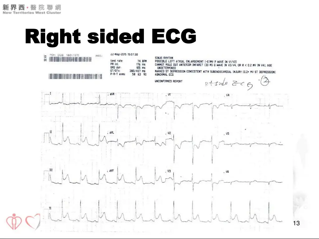 right sided ecg right sided ecg