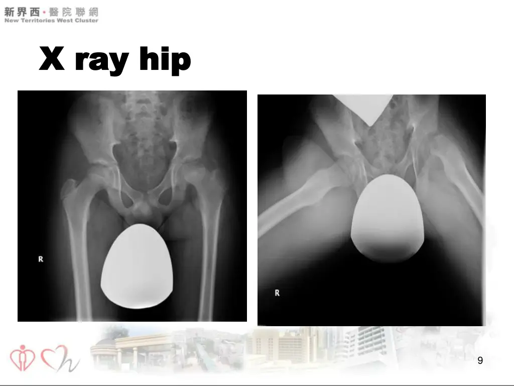 x ray hip x ray hip