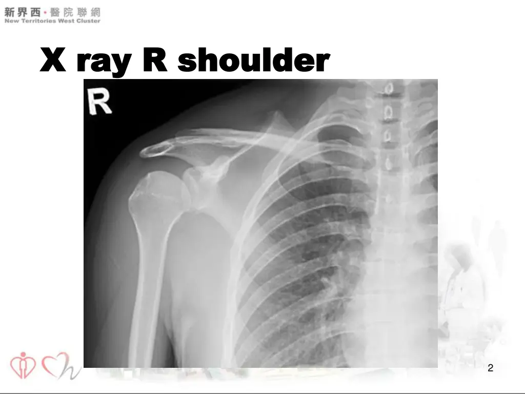 x ray r shoulder x ray r shoulder