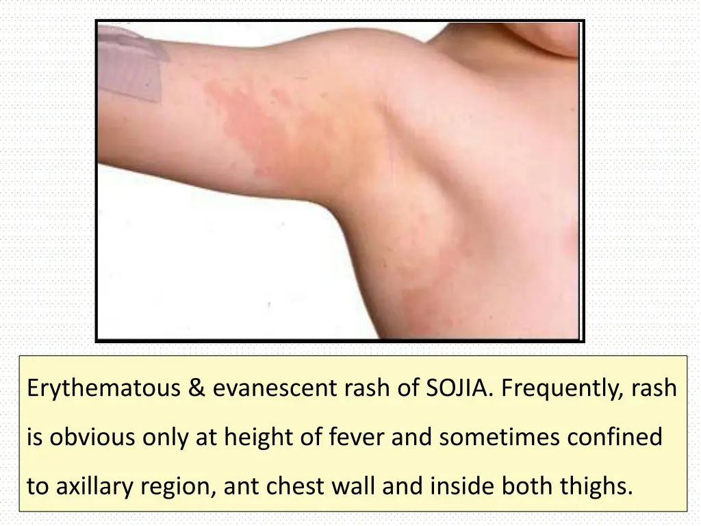 erythematous evanescent rash of sojia frequently