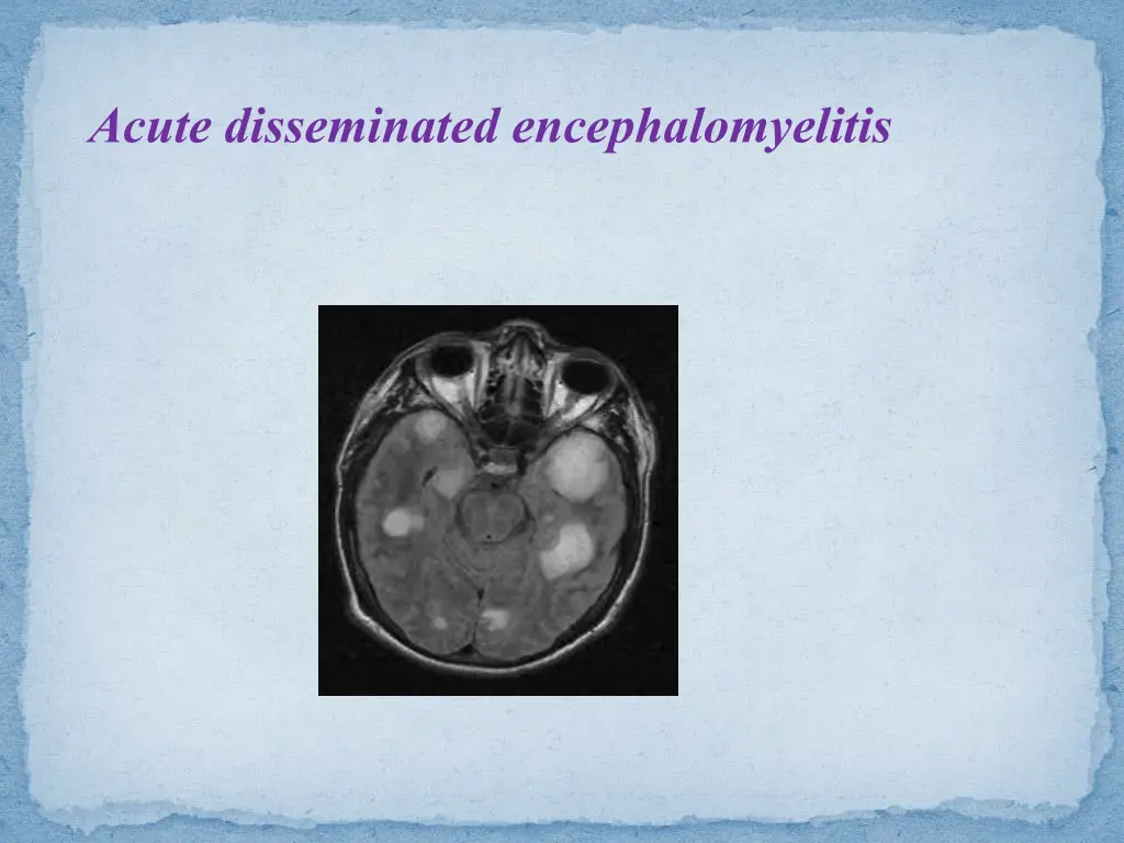 acute disseminated encephalomyelitis