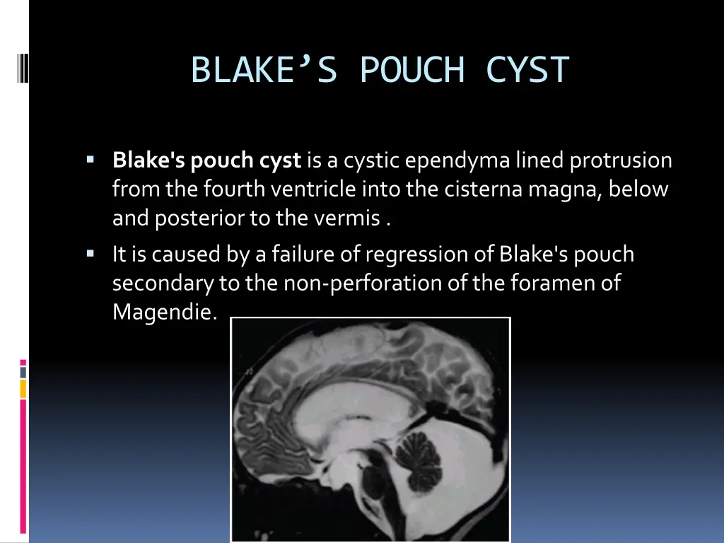 blake s pouch cyst