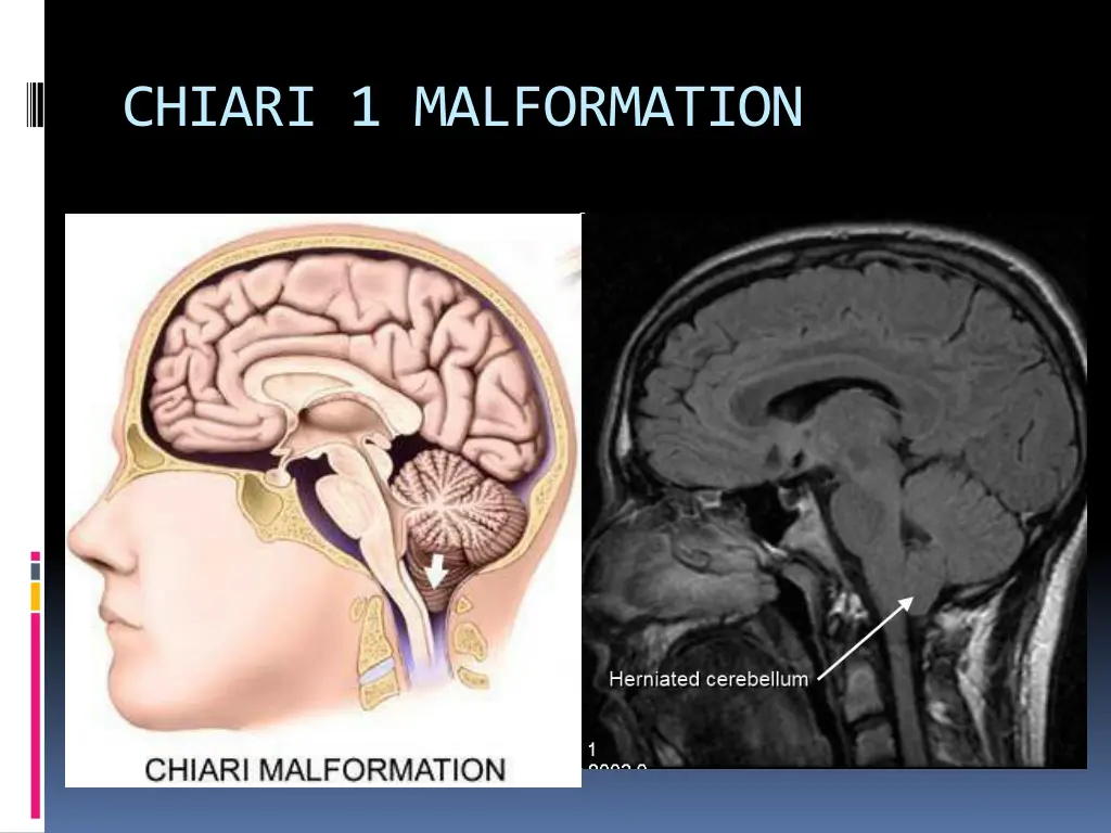 chiari 1 malformation 1